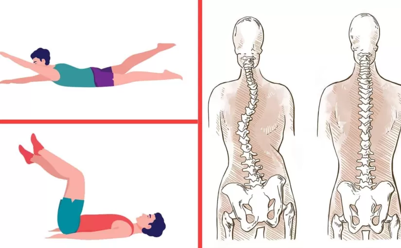 Penyakit Skoliosis Dan Olahraga Yang Di Anjurkan