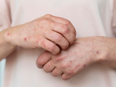 Ahli Kesehatan Peringatkan Munculnya Varian Mpox Baru