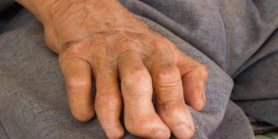 Kasus Kusta Muncul Di Rumania, Dua WNI Terinfeksi 