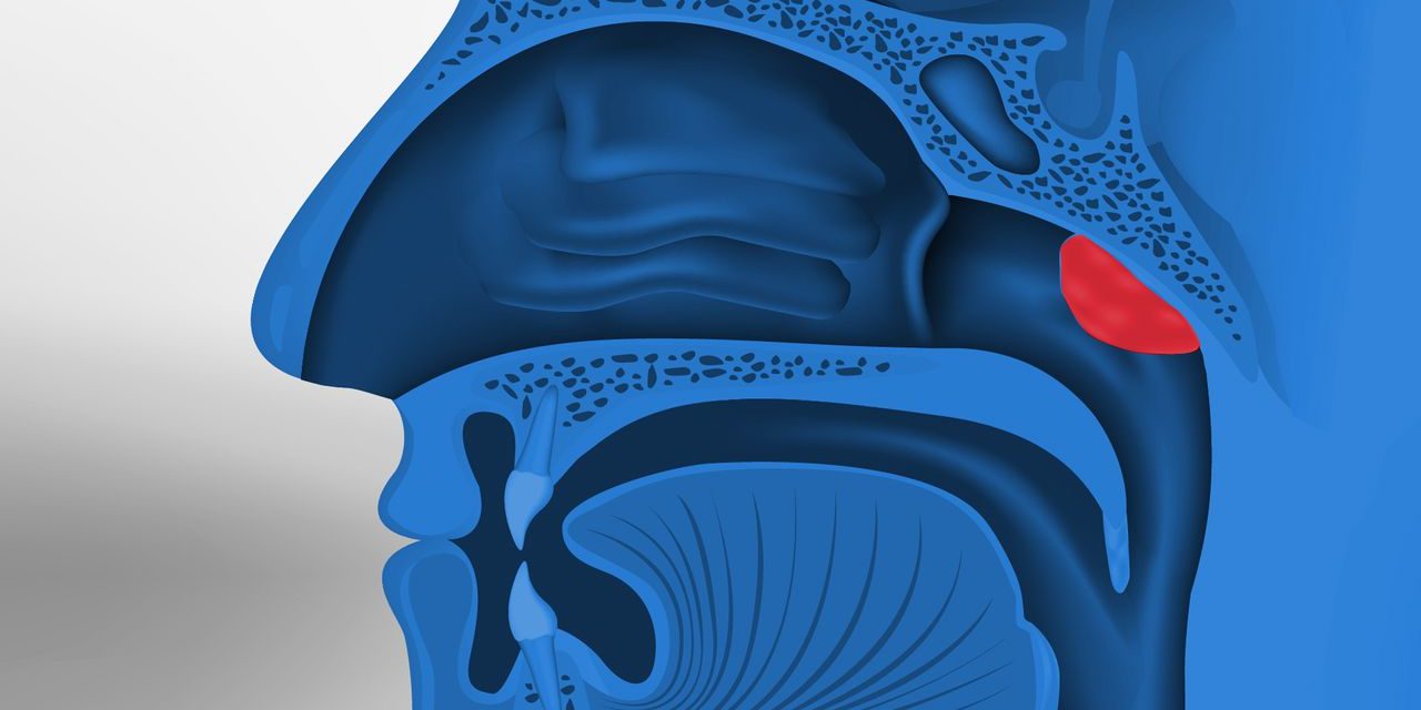 Adenoiditis, Peradangan Adenoid yang Sering Menyerang Anak