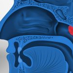 Adenoiditis, Peradangan Adenoid yang Sering Menyerang Anak