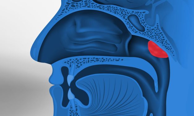Adenoiditis, Peradangan Adenoid yang Sering Menyerang Anak