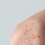 Cara Mengobati Ruam Mpox, Jangan Di garuk!