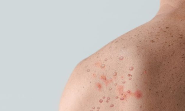 Cara Mengobati Ruam Mpox, Jangan Di garuk!