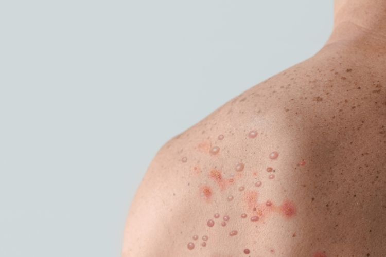 Cara Mengobati Ruam Mpox, Jangan Di garuk!